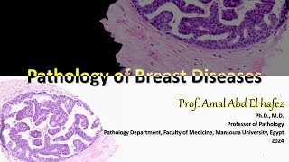 Breast Disease Pathology شرح محاضرة [upl. by Sheeree]