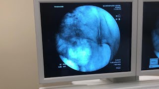 IntraArticular Injection of the Sacroiliac Joint Under Fluoroscopic Guidance [upl. by Ennyleuqcaj]