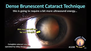 CataractCoach 1239 dense brunescent cataract technique [upl. by Hayn609]