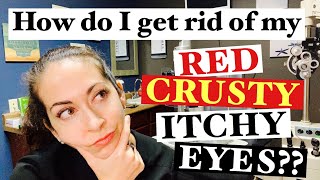 Blepharitis  2 Easy steps to banish red crusty itchy eyes  The Eye Surgeon [upl. by Delija]