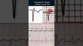 AVNRT ECG Pseudo R’ wave [upl. by Farrison30]