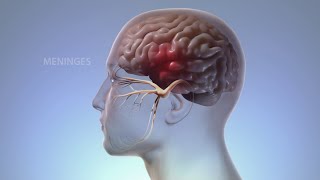 What Happens In Your Body During Migraine  WebMD [upl. by Zoes]