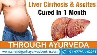 Ascites and Liver Cirrhosis Cure Through Ayurveda Real Testimonial [upl. by Druci]