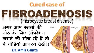 Fibroadenosis cured case [upl. by Ainoyek415]