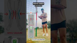 KNOCK KNEES WORD 🌎 BEST ✅ EXERCISE 👀💯 fitnesstips [upl. by Bourn]