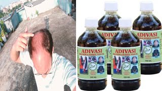 Ayurvedic Adivasi Bhringraj Herbal Hair oil  honest review [upl. by Nnaeirual]