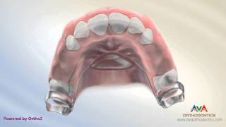 Orthodontic Space Management  Nance Appliance [upl. by Connors510]