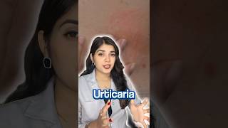 How I Cured My Urticaria Chronic Hives  My Story [upl. by Aciraj]