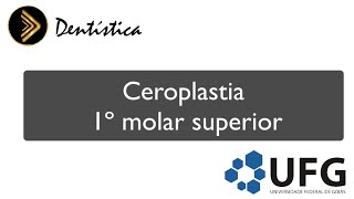 Ceroplastia 1º molar superior [upl. by Noyk380]