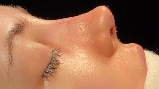 nose surgery rhinoplasty [upl. by Zadack]