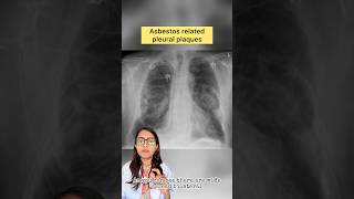 Asbestos induced pleural plaques asbestos pulmonary pulmonologist usmle medicalstudent medico [upl. by Jochebed]