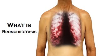 What is Bronchiectasis  Dr Technology [upl. by Sadirah748]