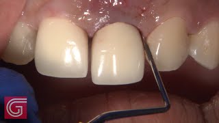 HOW TO Extract Fractured Tooth 9 for BruxZir Esthetic Part 2 of 3 [upl. by Doniv]