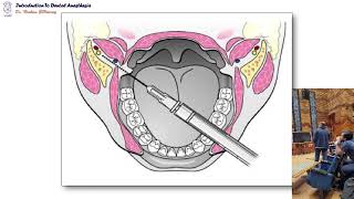 11 Supplementary anesthetic techniques [upl. by Oflodur]