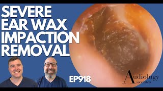 SEVERE EAR WAX IMPACTION REMOVAL  EP918 [upl. by Artemas859]