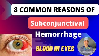 Blood in eyes  Subconjunctival Hemorrhage 8 Reasons and Treatment [upl. by Urion]