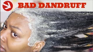 How To Permanently Cure Itchy Scalp amp Rid of Dandruff [upl. by Ottinger223]