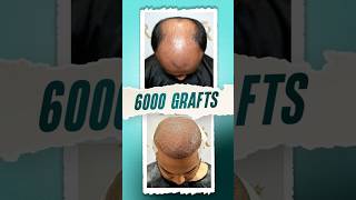 6000 Grafts Hair Transplant  Pune hairtransplant pune hair shorts [upl. by Dierdre]