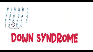 Trisomy 21Down Syndrome  sign and Symptoms Complications Diagnosis Management of Down syndrome [upl. by Keyte877]