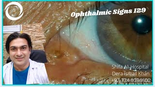 Ophthalmic Signs 129 [upl. by Odlavu885]