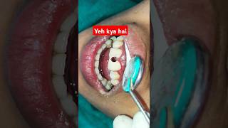 Dental Cavity in front teeth  dat kirale khayeko  Composite filling  Cosmetic treatment tooth [upl. by Golightly]