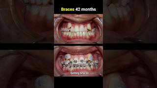 42 months for this braces casr braces orthodontist bracesoff bracesbeforeandafter [upl. by Shandie]