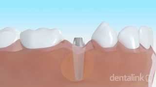 IMPLANTE DENTAL óseo integrado  Video 3D paso a paso [upl. by Ahsaele]