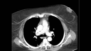 CT Chest PE poor contrast opacif DISCUSSION by Radiologist [upl. by Leina]