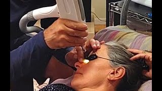 BCC 3  Our DIY Laser Treatment for Basal Cell Carcinoma [upl. by Aserahs]