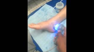 TRATAMIENTO DE LESION DE TOBILLO DE 2° GRADO CON LASER ULTRASONIDO ELECTROESTIMULACION [upl. by Dorej]