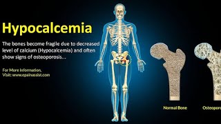 Treatment of hypocalcemia AACCM [upl. by Arihaj]