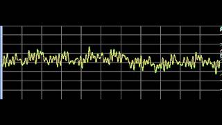 Hemorrhoids  Rife Frequencies [upl. by Eniarral338]