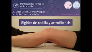 Rigidez de Rodilla y Artrofibrosis Artrolisis Artroscópica Artroscopia de Rodilla [upl. by Baggott]