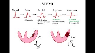 USMLE ACE Video 119 Coronary Artery Disease CAD and Congestive Heart Failure CHF [upl. by Rialc240]