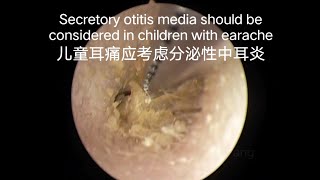 Children with earache should consider otitis media need to do earwax cleaning first儿童耳痛要考虑中耳炎要先清理耳垢 [upl. by Leribag]