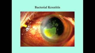 Keratitis  CRASH Medical Review Series [upl. by Eeznyl]