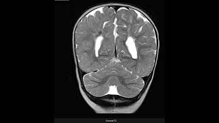 Leucomalácia periventricular [upl. by Pavyer]