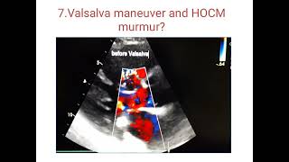 Hypertrophic cardiomyopathy echo  case presentation HOCM cardiology [upl. by Hepzi]