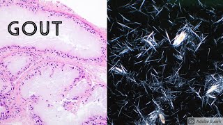 GOUT Under the Microscope Brilliant Polarizable Birefringent Monosodium Urate Crystals [upl. by Nnylhtak]