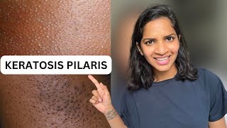 keratosis pilaris  keratosis pilaris causes  Keratosis pilaris treatment hindi [upl. by Ramsden773]