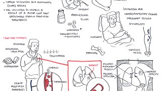 Pulmonary Embolism  Overview [upl. by Cece]