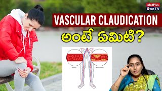 Vascular Claudication Symptoms and Treatment l Dr Niveditha Sai Chandra MedPlusONETV [upl. by Nele]