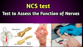 NCS Test  Nerve Conduction Study Procedure [upl. by Ymer859]