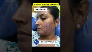 Salicylic acid peel  chemical peel  pimple peeling acne peel druttamkumarlenka acnetreament [upl. by Lyram399]