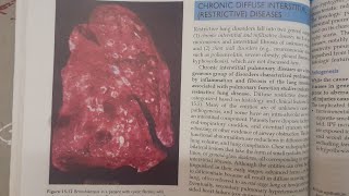 Bronchiectasis  SPECIAL PATHOLOGY [upl. by Verna]