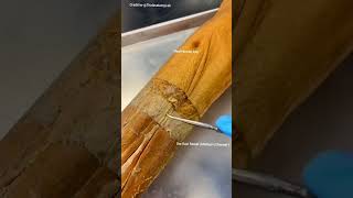 Real human leg skin layer Epidermis Dermis Hypodermis fat layer [upl. by Yemaj]