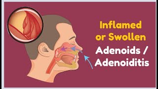 Inflamed or Swollen Adenoids  Adenoiditis [upl. by Seavir780]