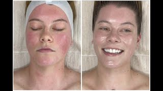 Calming Redness Blemishes amp Inflammation Facial Extractions  ASMR Meditation Jadeywadey180 [upl. by Noland]