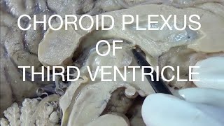 CHOROID PLEXUS OF THIRD VENTRICLE  An educational video [upl. by Myrah252]