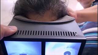 Multicanal BPPV with Canal Switch and Jam [upl. by Pardew168]